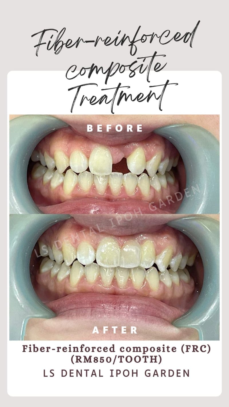 Jambatan Komposit Diperkukuh Gentian — before and after, LS Dental Clinic Ipoh Garden