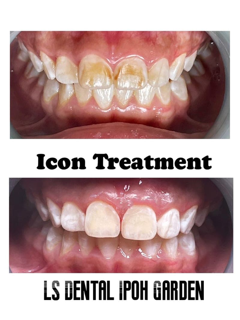 Icon — Rawatan Fluorosis — before and after, LS Dental Clinic Ipoh Garden