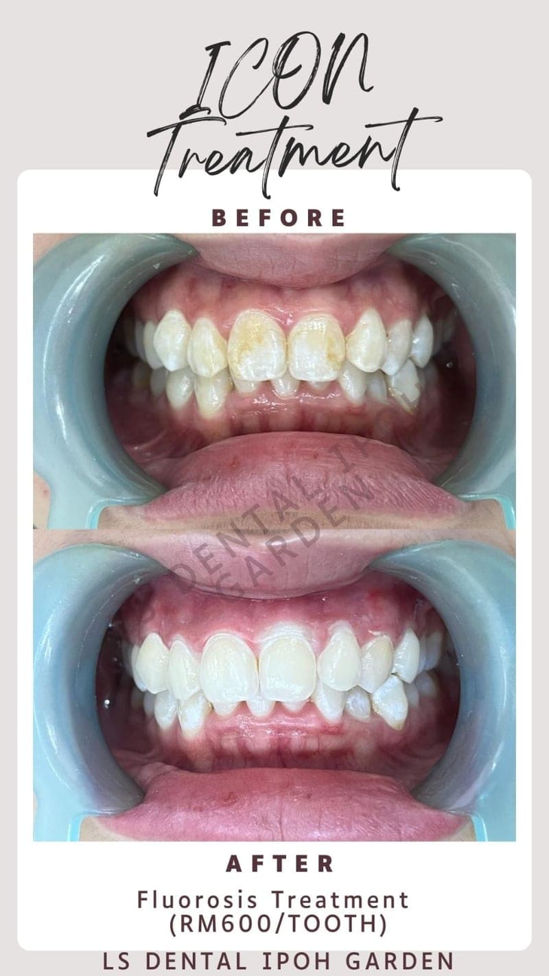 Icon — Rawatan Tompok Putih — before and after, LS Dental Clinic Ipoh Garden