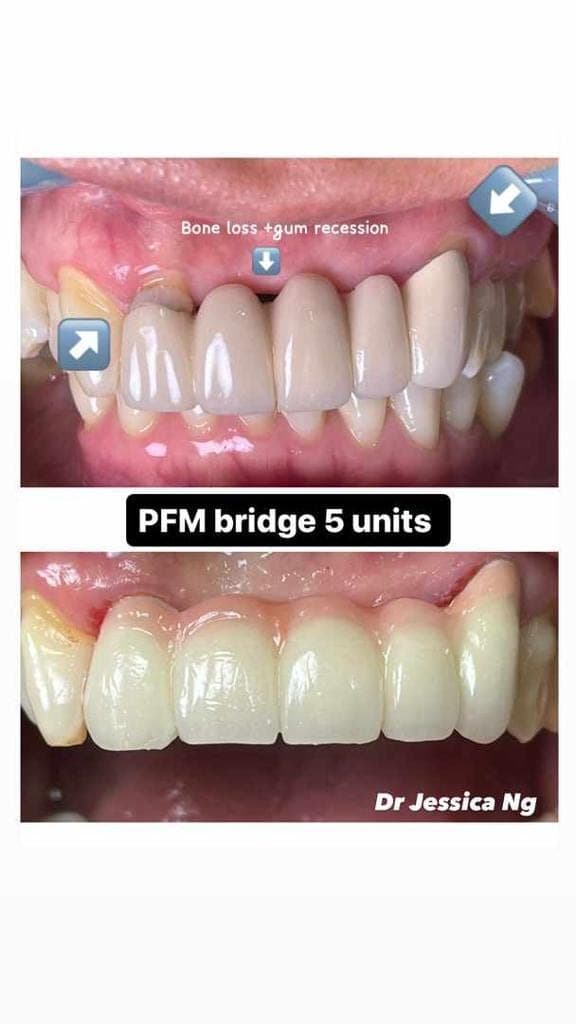 Jambatan PFM (5 Unit) — before and after, LS Dental Clinic Ipoh Garden
