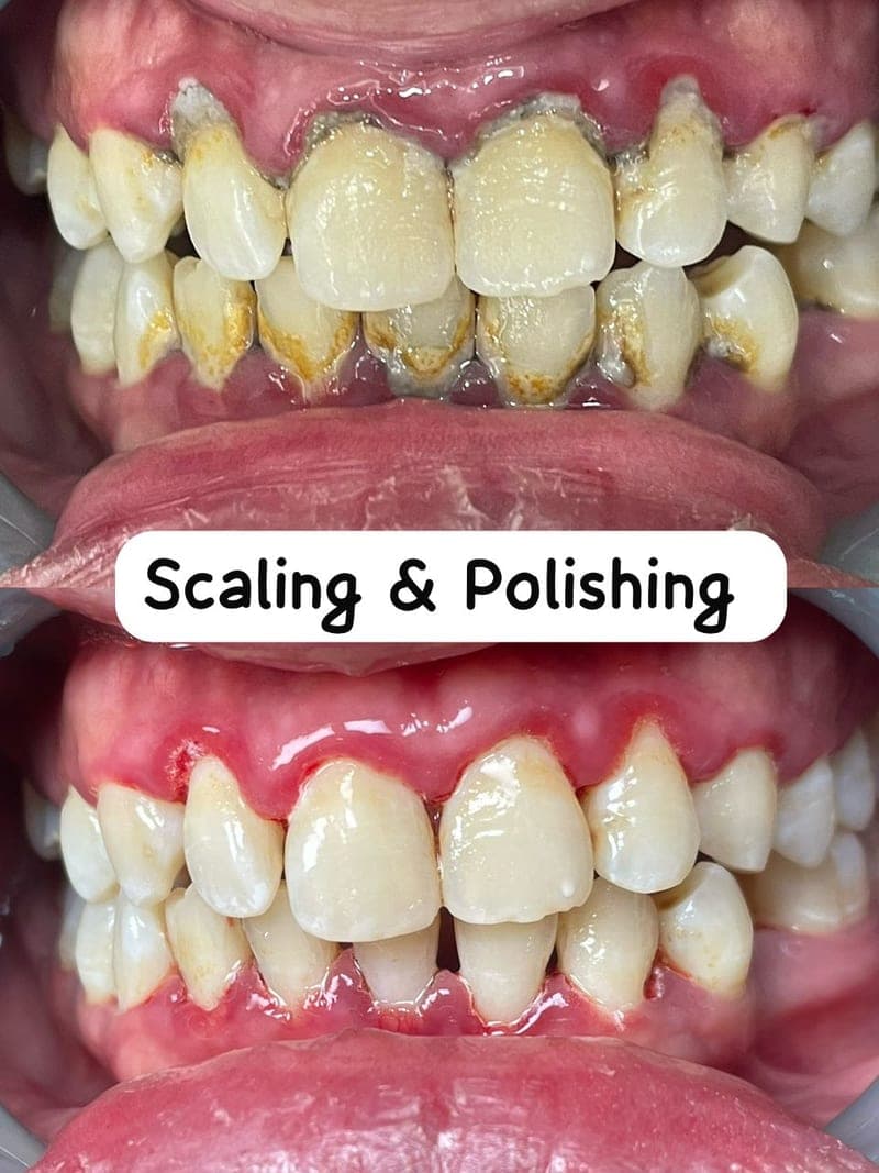 Cuci Karang & Penggilap — before and after, LS Dental Clinic Ipoh Garden