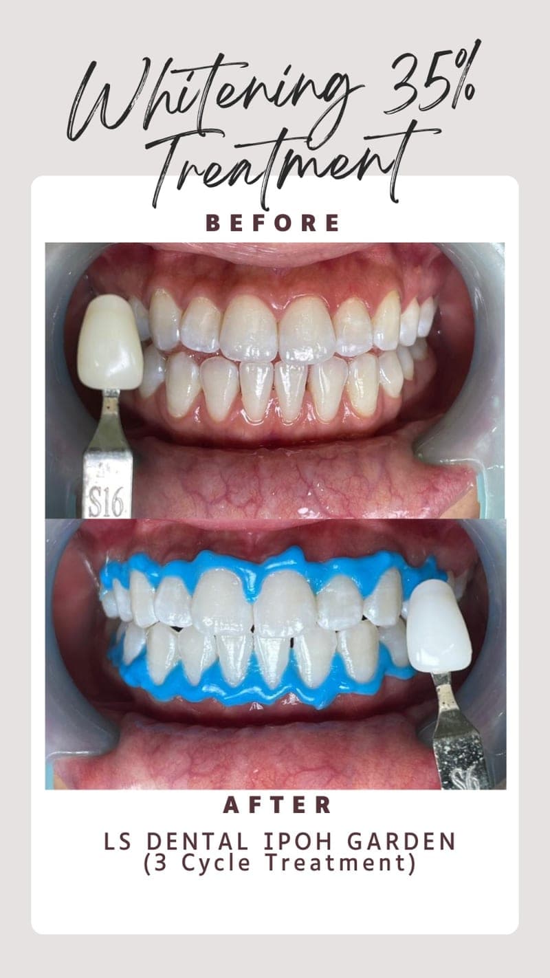 Pemutihan Gigi (3 Kitaran) — before and after, LS Dental Clinic Ipoh Garden