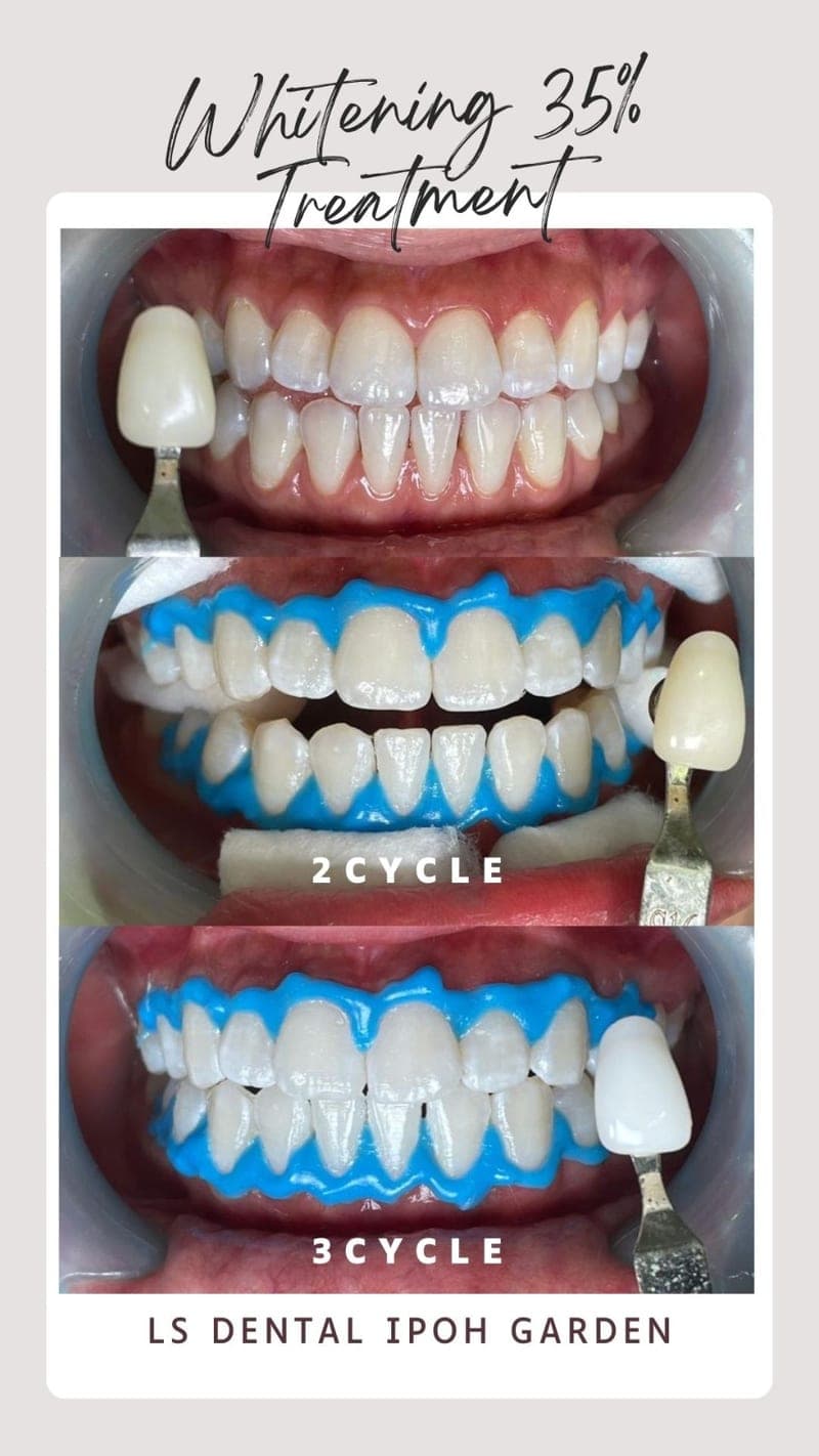 Pemutihan Gigi (35%) — before and after, LS Dental Clinic Ipoh Garden