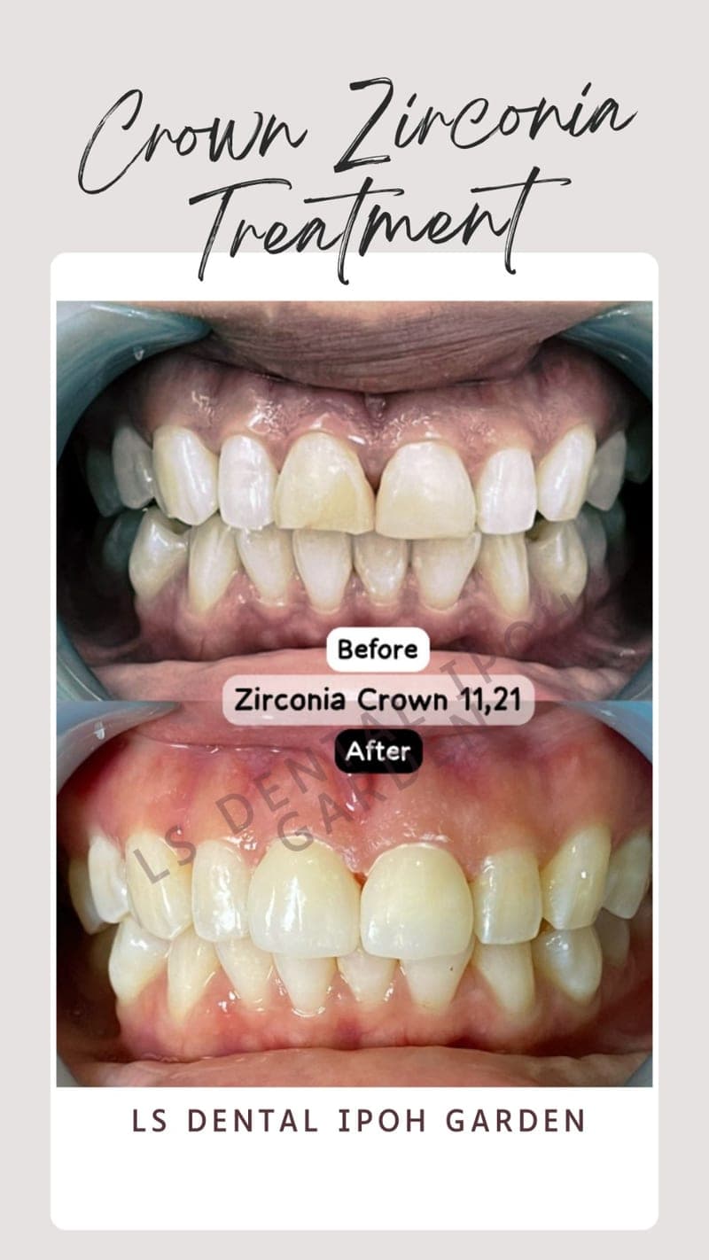 Mahkota Zirconia — before and after, LS Dental Clinic Ipoh Garden